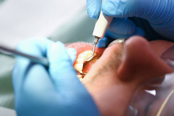 Best Emergency Dental Care for Sports Injuries in Clover Creek, WA